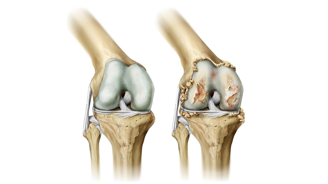 Instrucciones para usar Hondrolife del dolor articular