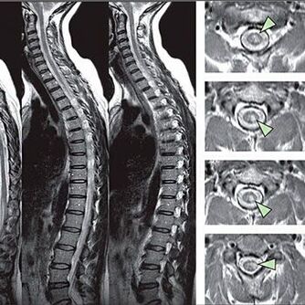 Diagnóstico de osteocondrosis torácica