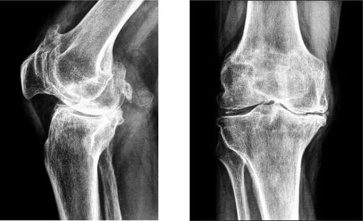 Gonartrosis de la articulación de la rodilla en radiografía.