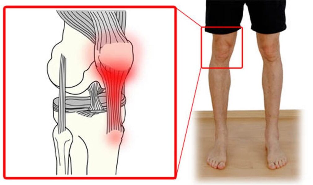 Tendinitis inflamación de los tendones de la articulación de la rodilla.