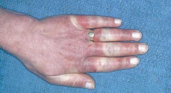 Cuadro clínico del síndrome de Raynaud vasoespasmo, hiperemia, edema.
