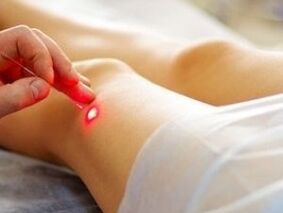 Tratamiento de la artrosis de la articulación de la rodilla con un láser